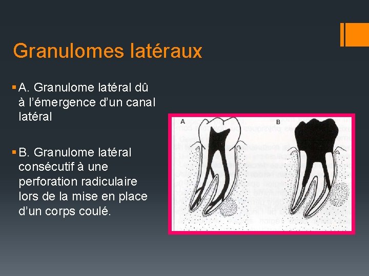 Granulomes latéraux § A. Granulome latéral dû à l’émergence d’un canal latéral § B.