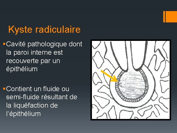Kyste radiculaire § Cavité pathologique dont la paroi interne est recouverte par un épithélium