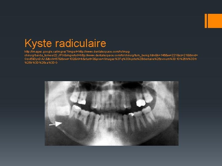 Kyste radiculaire http: //images. google. ca/imgres? imgurl=http: //www. dentalespace. com/fc/imagchirurg/barda_tumeur 22. JPG&imgrefurl=http: //www. dentalespace.