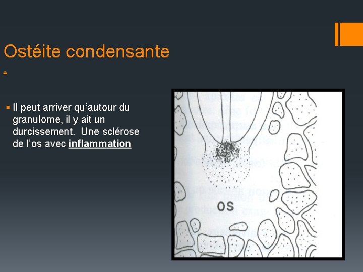 Ostéite condensante. § Il peut arriver qu’autour du granulome, il y ait un durcissement.