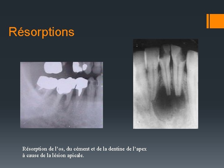 Résorptions Résorption de l’os, du cément et de la dentine de l’apex à cause