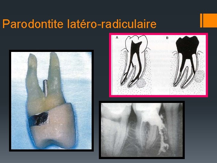 Parodontite latéro-radiculaire 