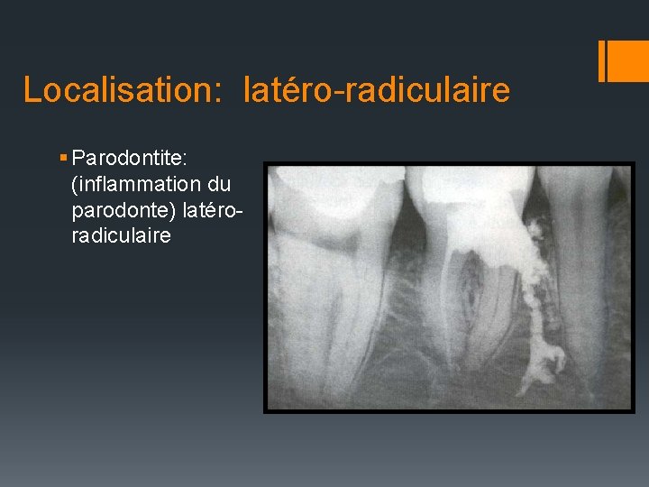 Localisation: latéro-radiculaire § Parodontite: (inflammation du parodonte) latéroradiculaire 