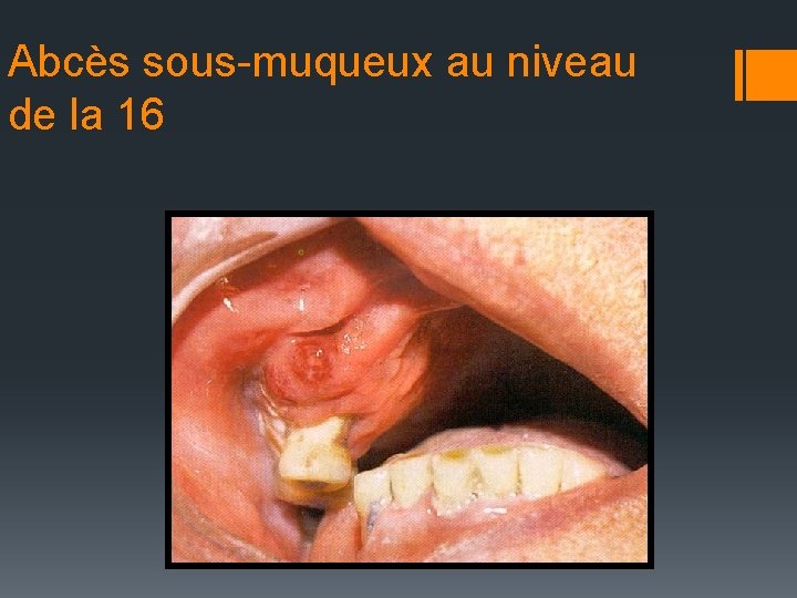 Abcès sous-muqueux au niveau de la 16 