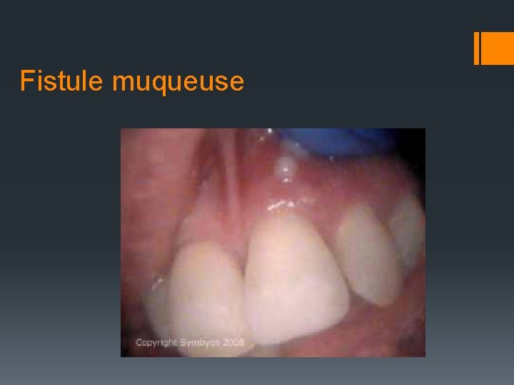 Fistule muqueuse 