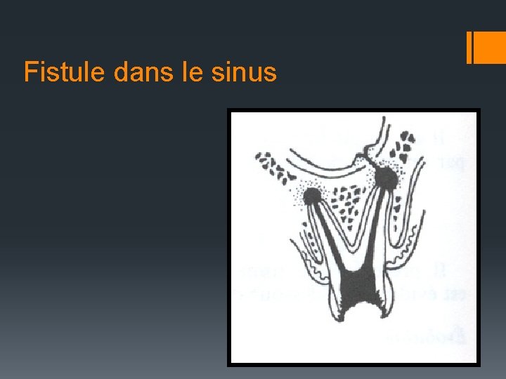 Fistule dans le sinus 