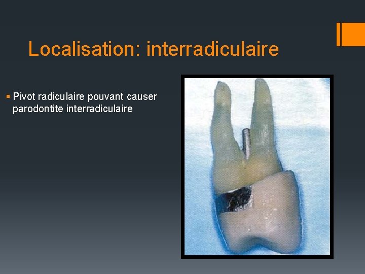 Localisation: interradiculaire § Pivot radiculaire pouvant causer parodontite interradiculaire 