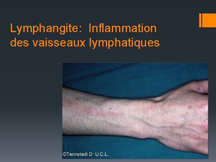 Lymphangite: Inflammation des vaisseaux lymphatiques 