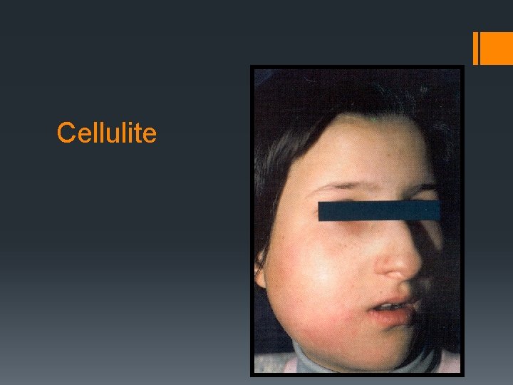 Cellulite 