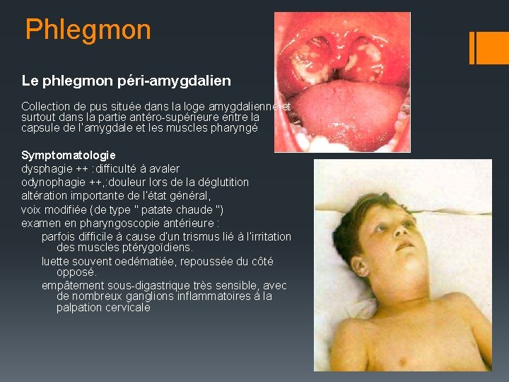 Phlegmon Le phlegmon péri-amygdalien Collection de pus située dans la loge amygdalienne et surtout