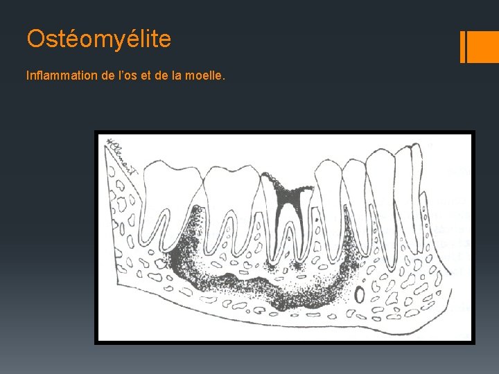 Ostéomyélite Inflammation de l’os et de la moelle. 