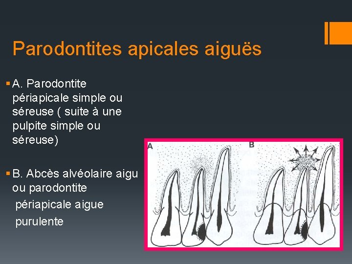 Parodontites apicales aiguës § A. Parodontite périapicale simple ou séreuse ( suite à une