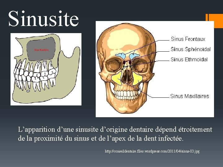 Sinusite L’apparition d’une sinusite d’origine dentaire dépend étroitement de la proximité du sinus et