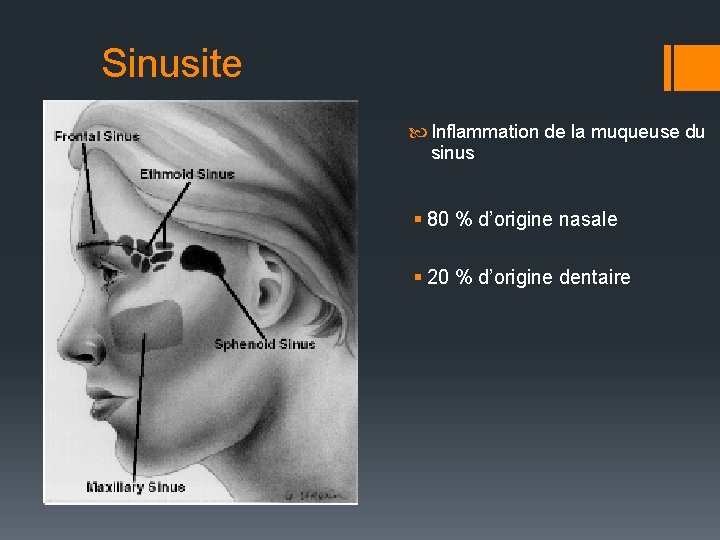 Sinusite Inflammation de la muqueuse du sinus § 80 % d’origine nasale § 20