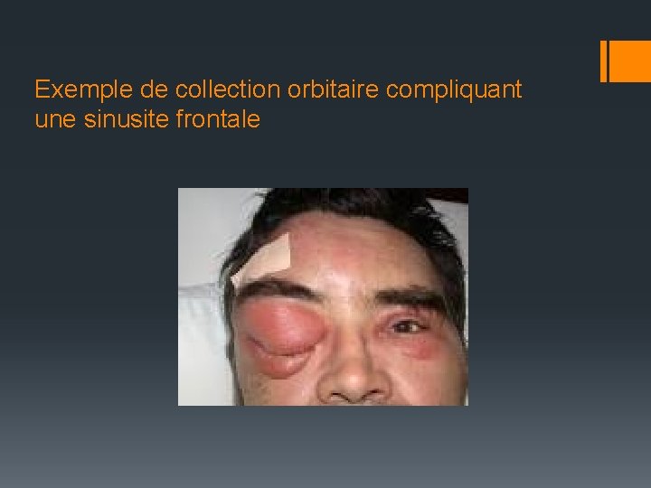 Exemple de collection orbitaire compliquant une sinusite frontale 