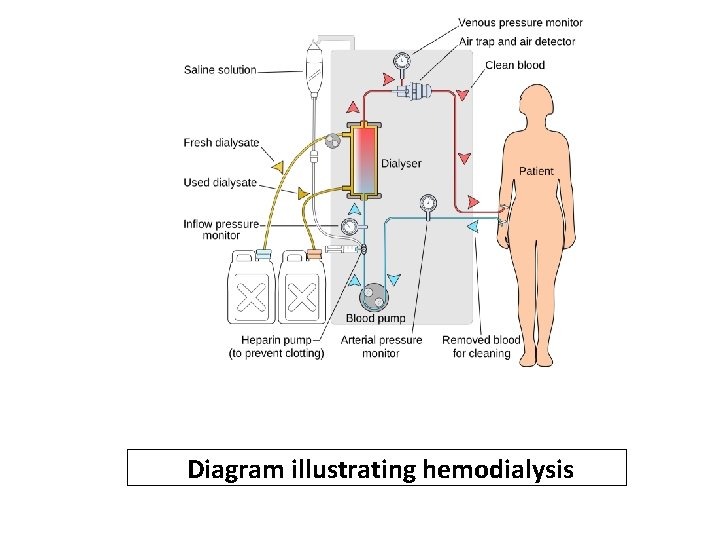 Diagram illustrating hemodialysis 