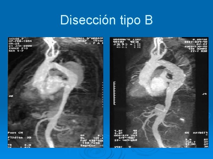 Disección tipo B 