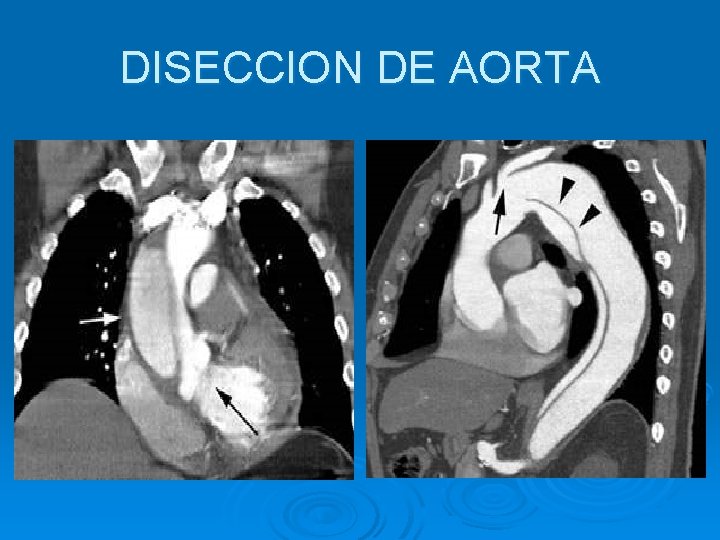 DISECCION DE AORTA 