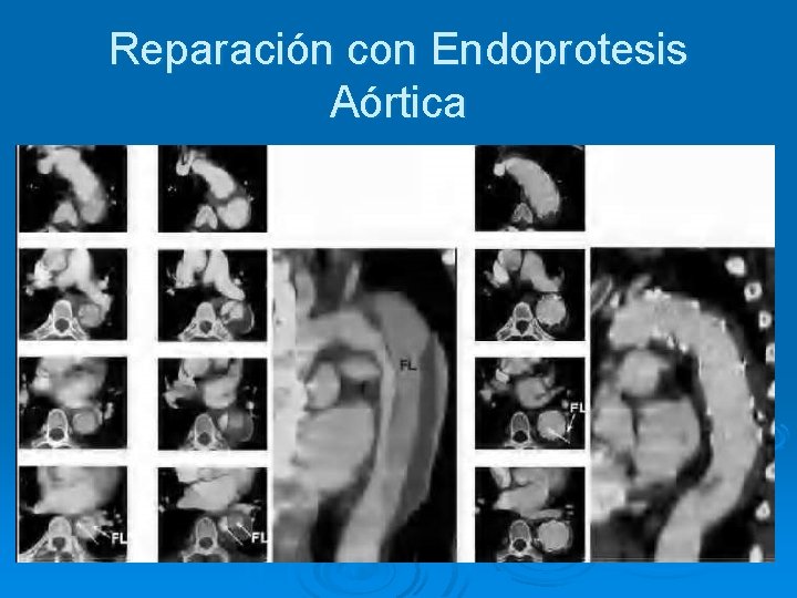 Reparación con Endoprotesis Aórtica 