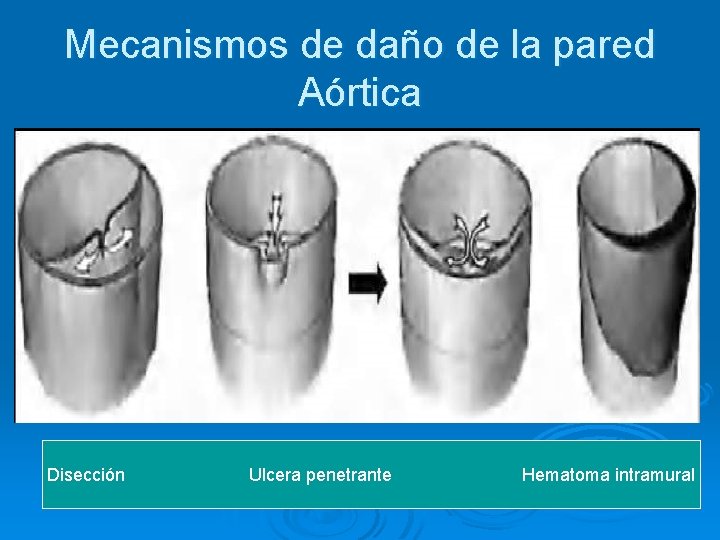 Mecanismos de daño de la pared Aórtica Disección Ulcera penetrante Hematoma intramural 
