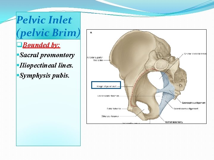 Pelvic Inlet (pelvic Brim) q. Bounded by: §Sacral promontory §Iliopectineal lines. §Symphysis pubis. 