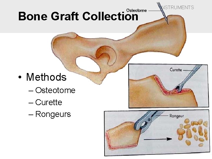 Bone Graft Collection • Methods – Osteotome – Curette – Rongeurs INSTRUMENTS 