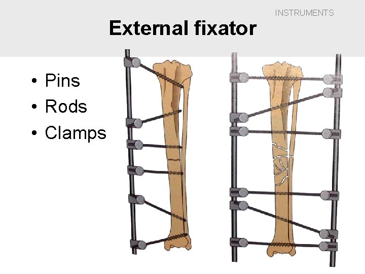 External fixator • Pins • Rods • Clamps INSTRUMENTS 