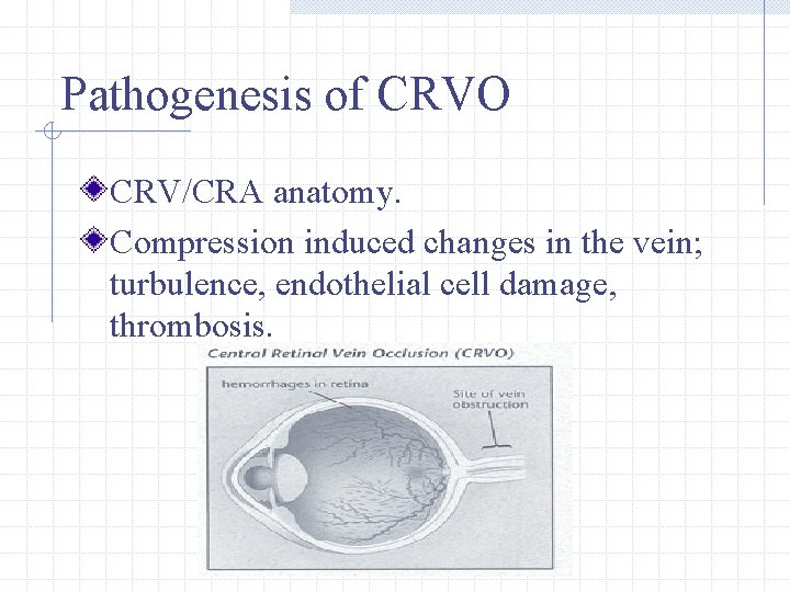 Pathogenesis of CRVO CRV/CRA anatomy. Compression induced changes in the vein; turbulence, endothelial cell