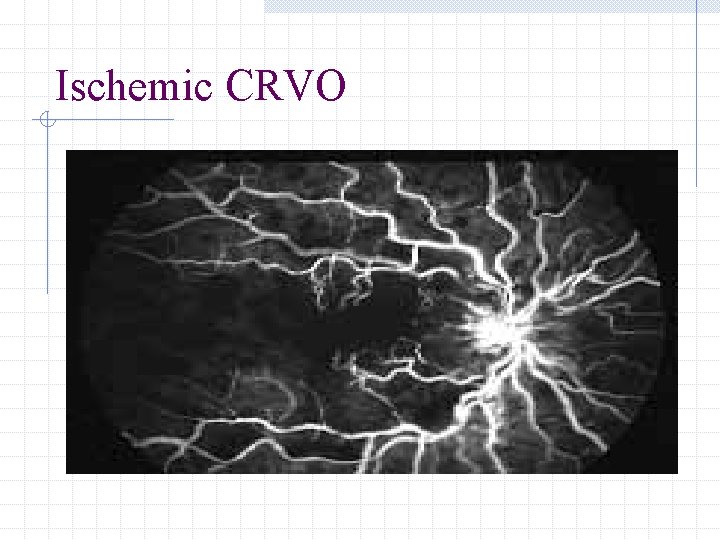 Ischemic CRVO 