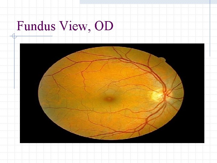 Fundus View, OD 