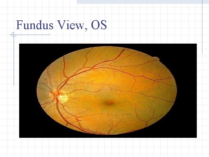 Fundus View, OS 