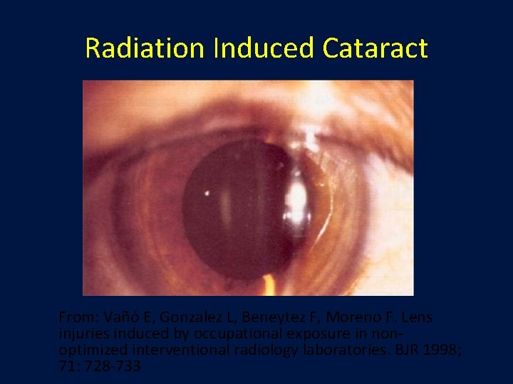 Radiation Induced Cataract From: Vañó E, Gonzalez L, Beneytez F, Moreno F. Lens injuries Radiation Induced Cataract From: Vañó E, Gonzalez L, Beneytez F, Moreno F. Lens injuries