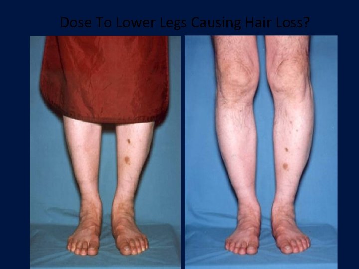 Dose To Lower Legs Causing Hair Loss? Dose To Lower Legs Causing Hair Loss?
