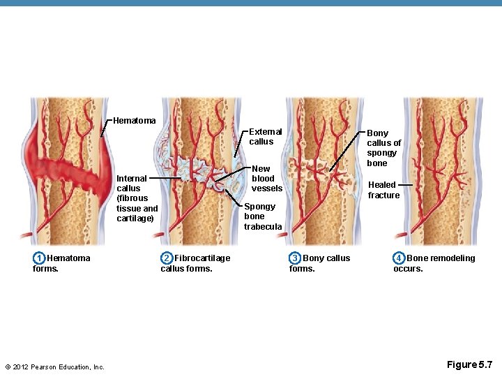 Hematoma External callus New blood vessels Internal callus (fibrous tissue and cartilage) 1 Hematoma