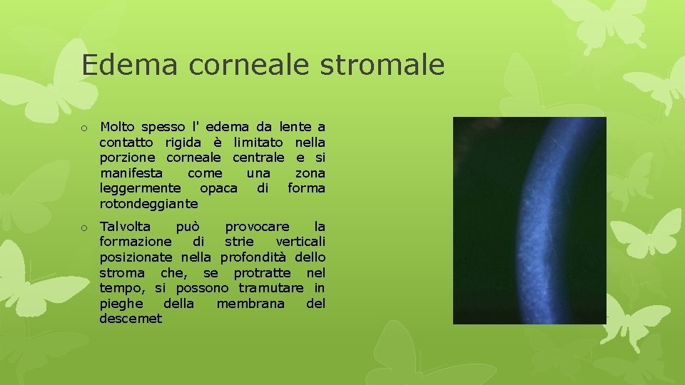 Edema corneale stromale o Molto spesso l' edema da lente a contatto rigida è