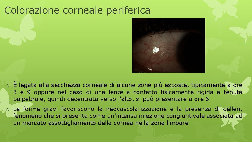 Colorazione corneale periferica o È legata alla secchezza corneale di alcune zone più esposte,