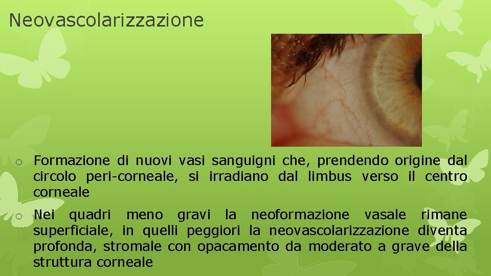 Neovascolarizzazione o Formazione di nuovi vasi sanguigni che, prendendo origine dal circolo peri-corneale, si