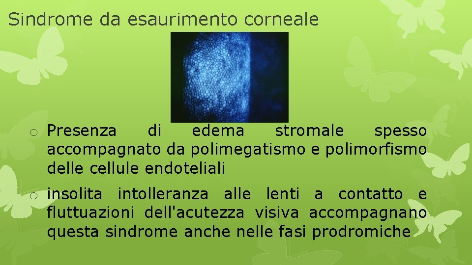 Sindrome da esaurimento corneale o Presenza di edema stromale spesso accompagnato da polimegatismo e