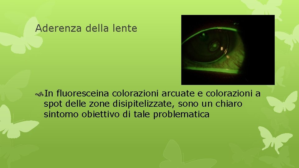 Aderenza della lente In fluoresceina colorazioni arcuate e colorazioni a spot delle zone disipitelizzate,