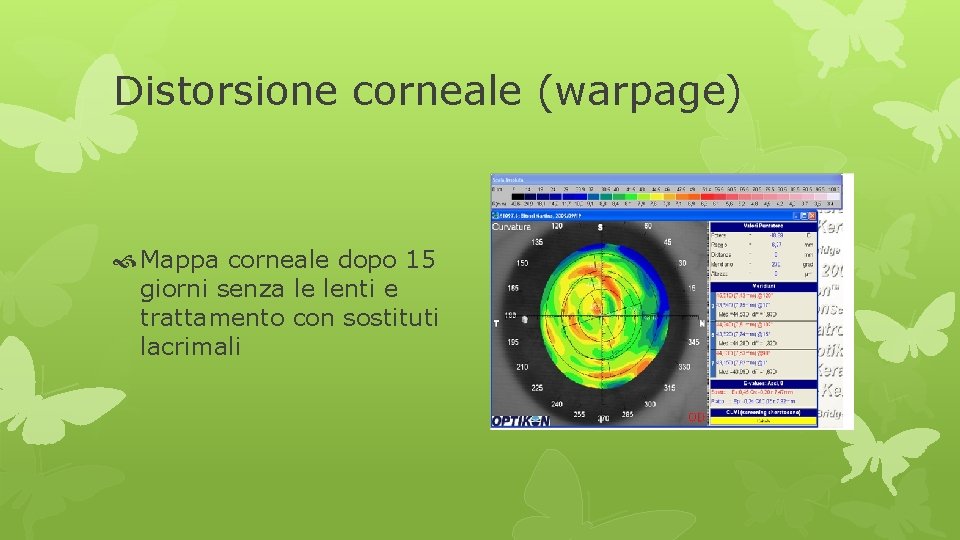 Distorsione corneale (warpage) Mappa corneale dopo 15 giorni senza le lenti e trattamento con