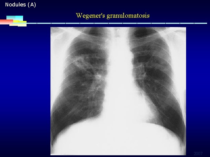 Nodules (A) Wegener's granulomatosis 2007 