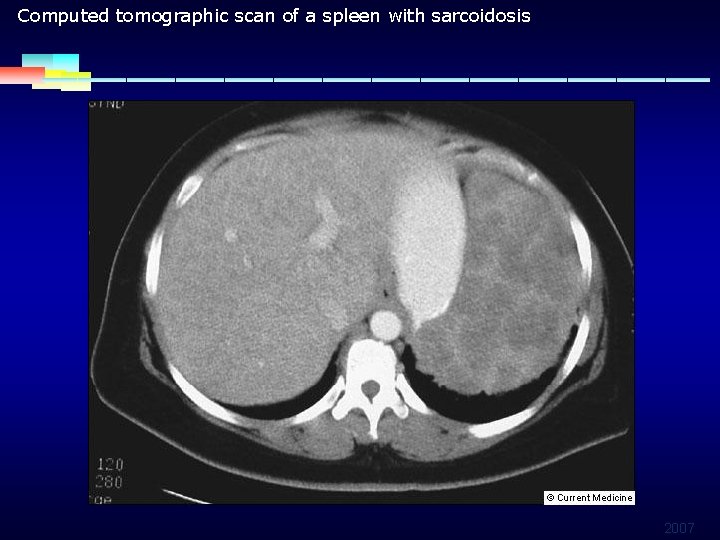 Computed tomographic scan of a spleen with sarcoidosis 2007 