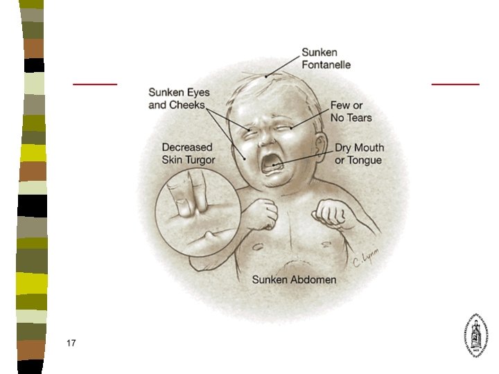 Diarrhe Aigu Dshydratation De Lenfant Dr Thomassin Cours