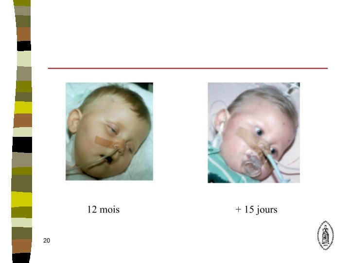 Diarrhe Aigu Dshydratation De Lenfant Dr Thomassin Cours