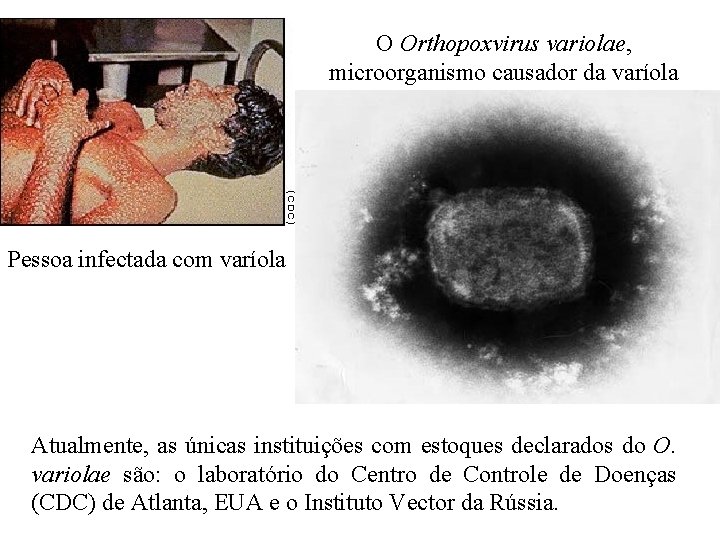 O Orthopoxvirus variolae, microorganismo causador da varíola Pessoa infectada com varíola Atualmente, as únicas