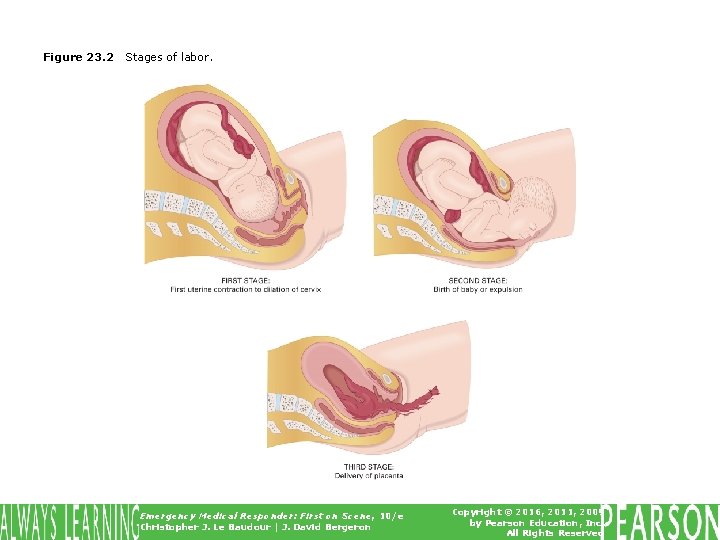 Figure 23. 2 Stages of labor. Emergency Medical Responder: First on Scene, 10/e Christopher