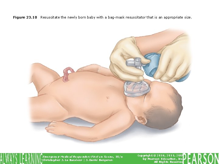 Figure 23. 10 Resuscitate the newly born baby with a bag-mask resuscitator that is