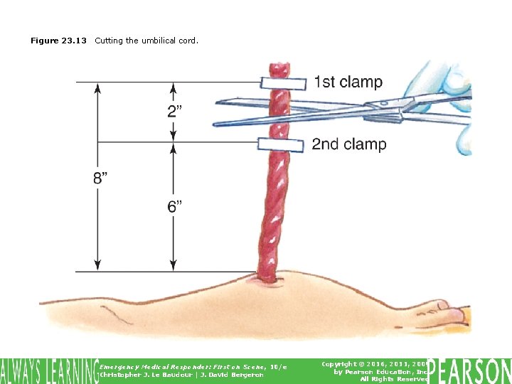 Figure 23. 13 Cutting the umbilical cord. Emergency Medical Responder: First on Scene, 10/e