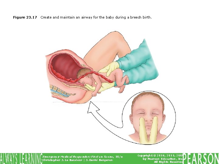 Figure 23. 17 Create and maintain an airway for the baby during a breech