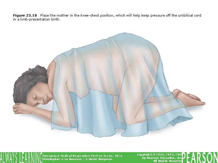 Figure 23. 18 Place the mother in the knee-chest position, which will help keep